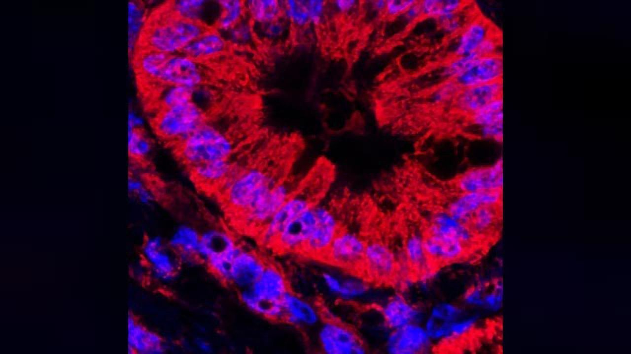 Fungal Invasion Fuels Pancreatic Cancer Growth