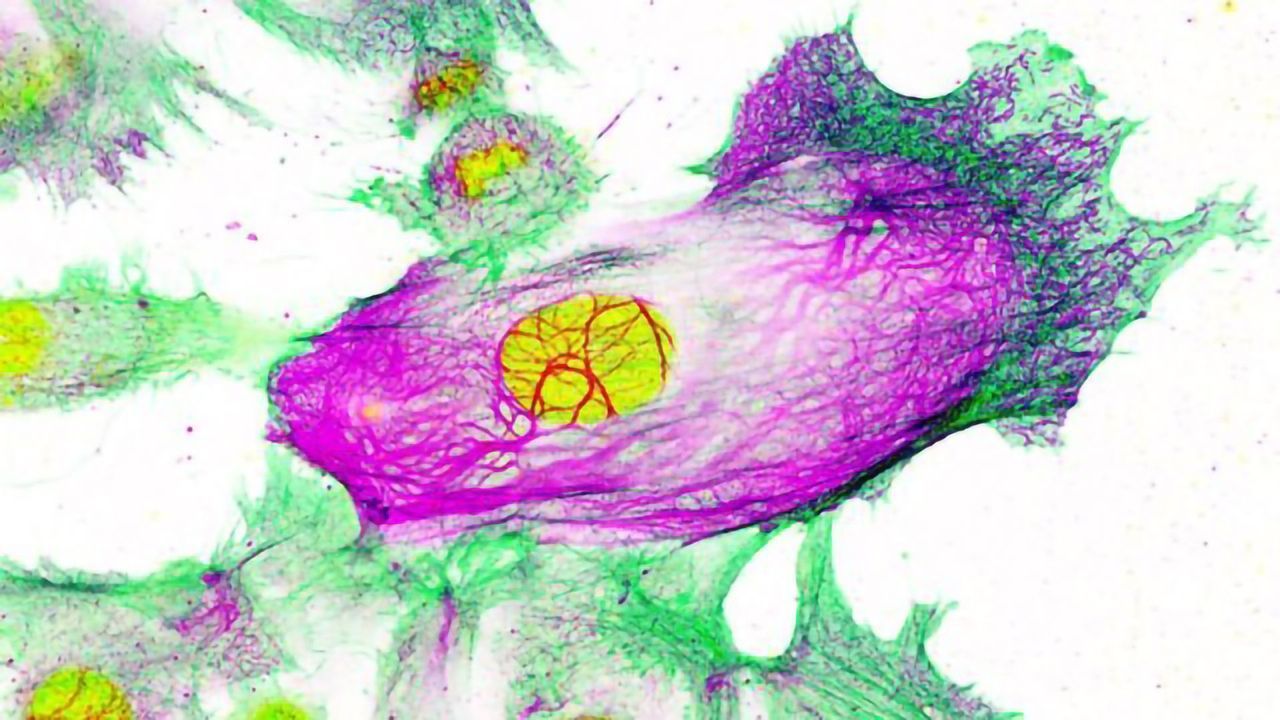 "Switch" Helps Breast Cancer Spread Around the Body