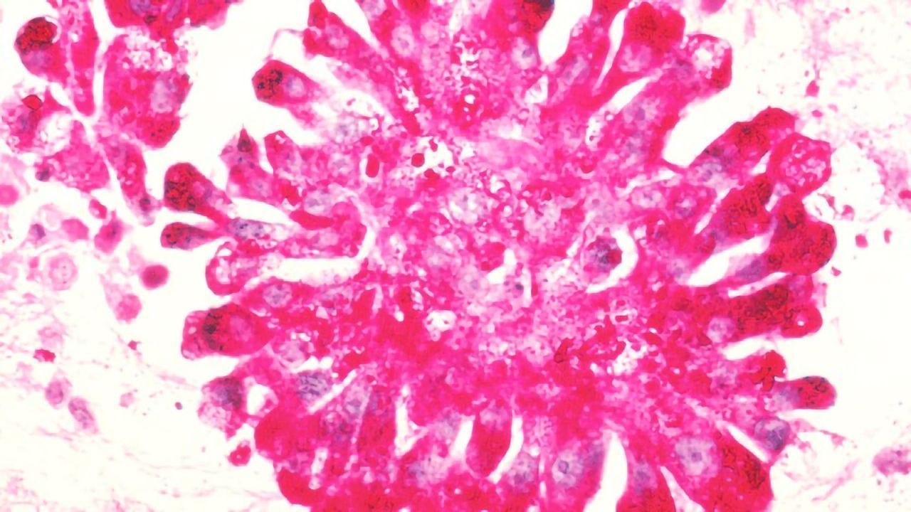 Blocking Children’s Bone Cancer
