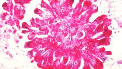 Blocking Children’s Bone Cancer