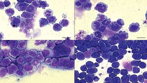 Mutant “Partners in Crime” Make Blood Cancer Deadlier