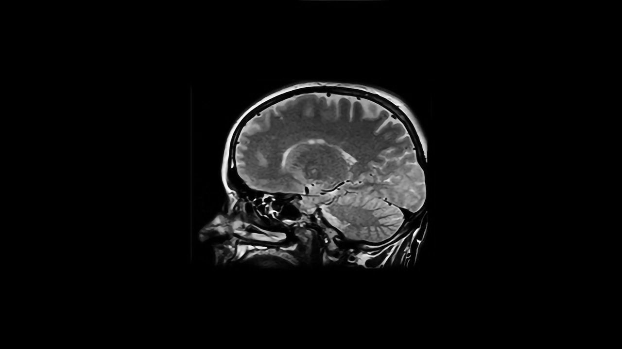 Stem Cells Present Parallel Opportunities for Neurological Condition