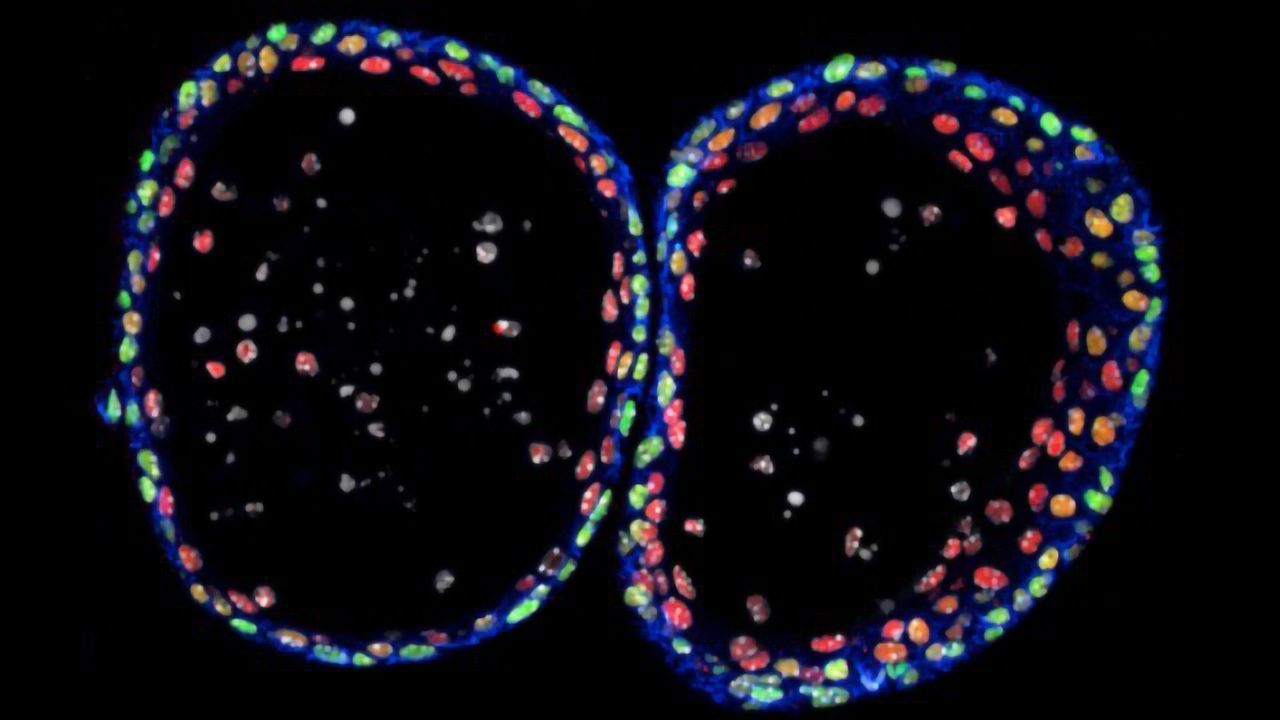 Urothelial Organoids Could Advance Bladder Cancer Research