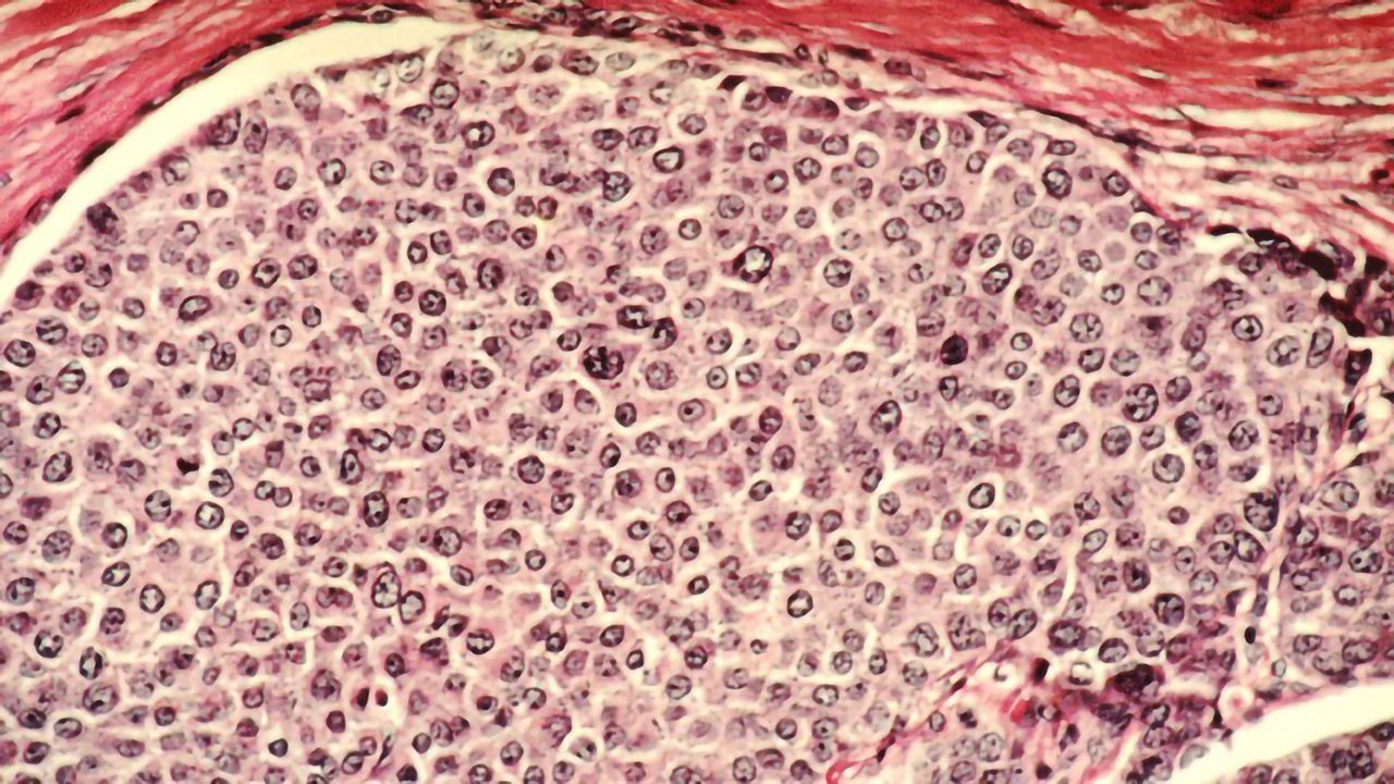 Treatment of Male Breast Cancer is Evolving