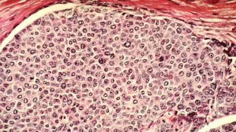 Treatment of Male Breast Cancer is Evolving
