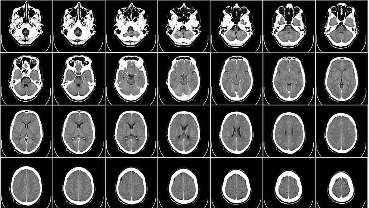 A Surprising Contributor to Multiple Sclerosis
