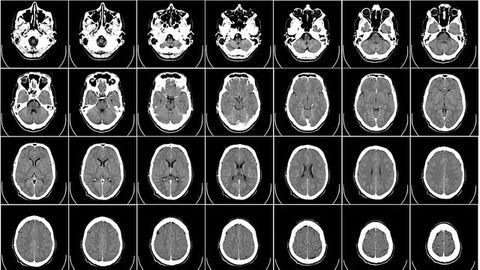 A Surprising Contributor to Multiple Sclerosis