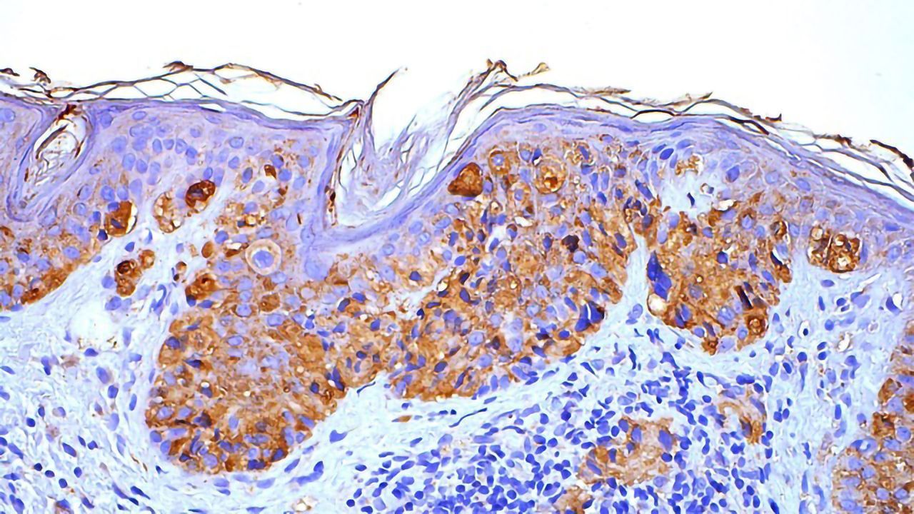Melanoma Variability at the Single-cell Level Can Predict Treatment Response