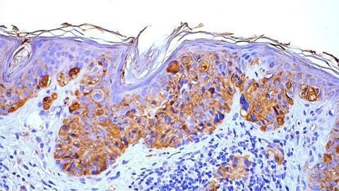 Melanoma Variability at the Single-cell Level Can Predict Treatment Response