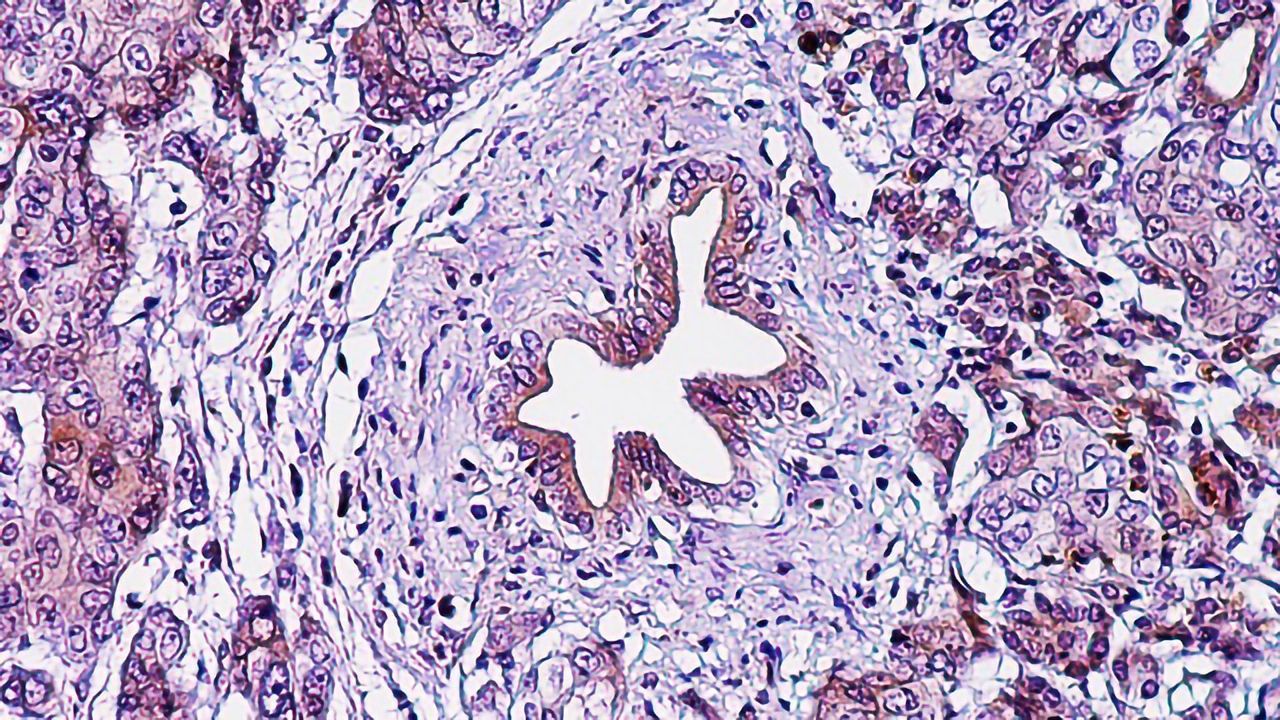 Novel Pancreatic Cancer Treatment May Rev Up Immune System