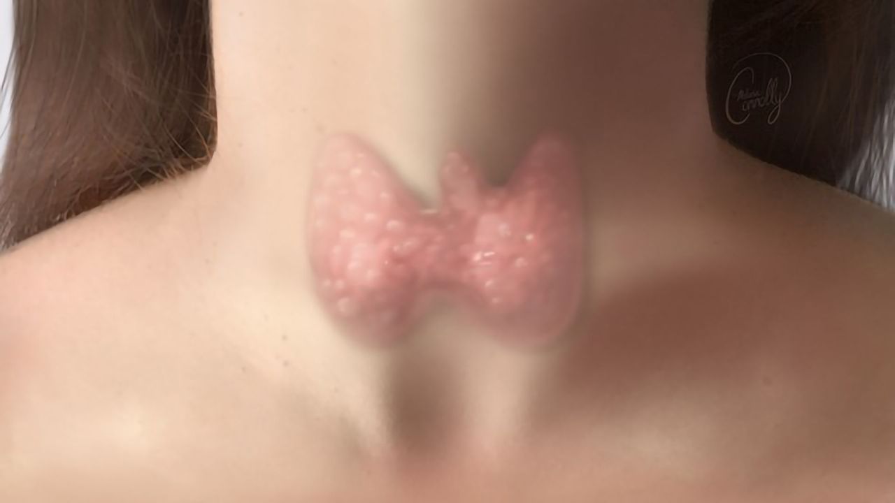 New Test for Thyroid Cancer Could Prevent Unnecessary Surgery