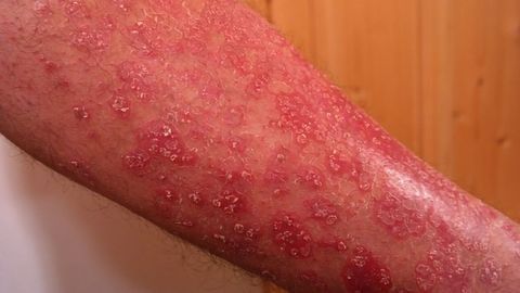 Concerning Undertreatment of Autoimmune Condition Psoriasis