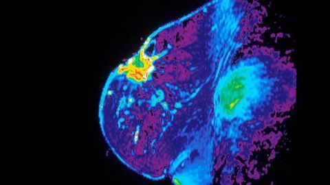 Imaging Tumor Stiffness To Enhance Breast and Pancreatic Cancer Treatments