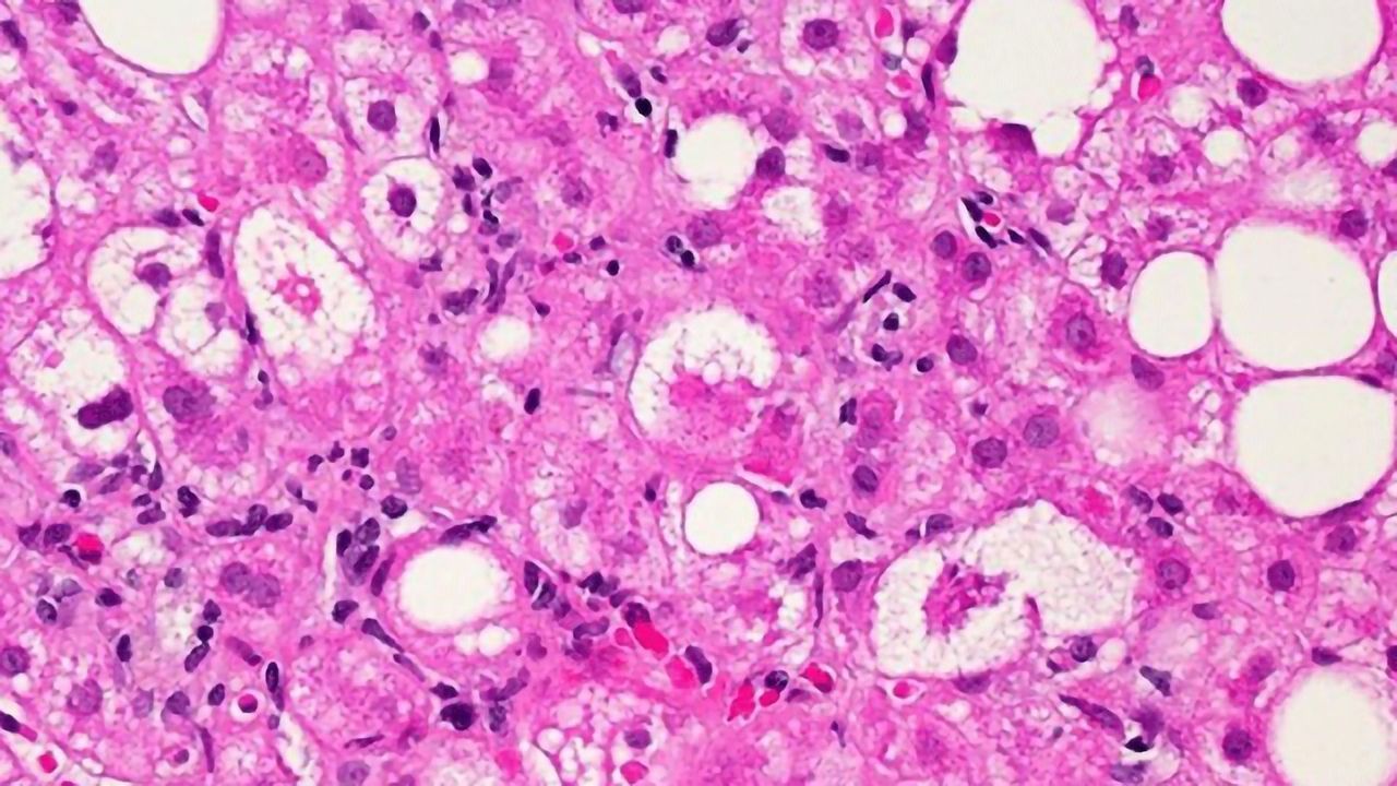 Drug Prevents Liver Scarring in People With HIV