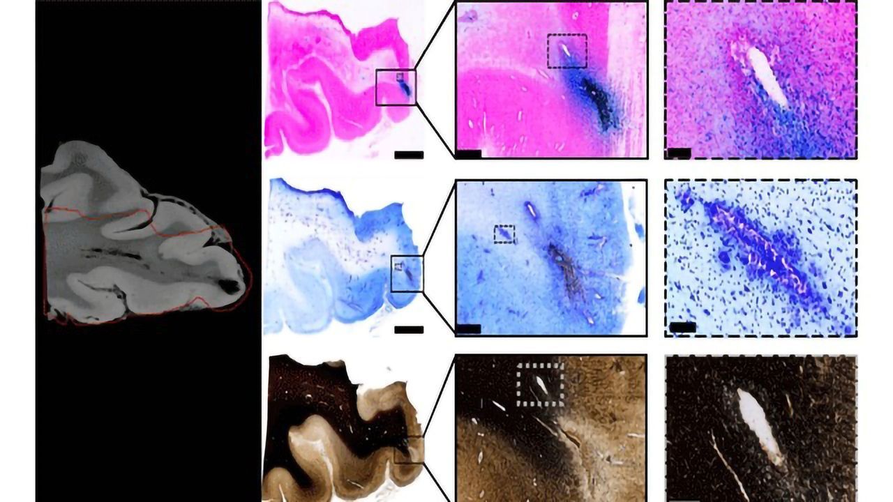 New Insights Could Change How Concussions Are Treated