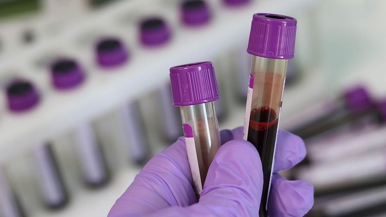 Changes Associated With Alzheimer's Disease Detectable in Blood Samples