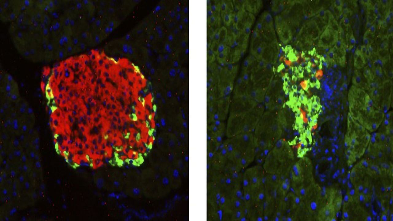 Will a Next-generation Therapy for Diabetes Soon Be Available?