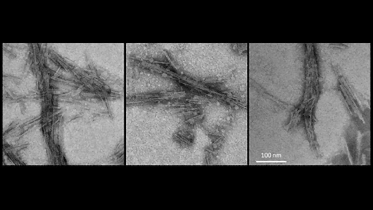 Test for Uncommon Brain Diseases Developed