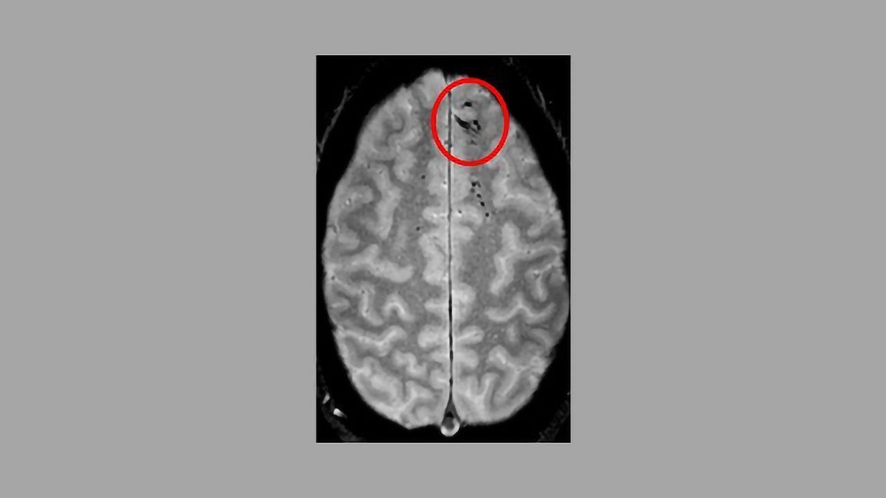 Microbleeds May Be Sign of Trauma After Minor Brain Injury