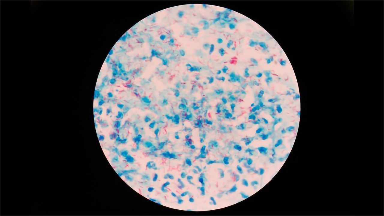 Tuberculosis