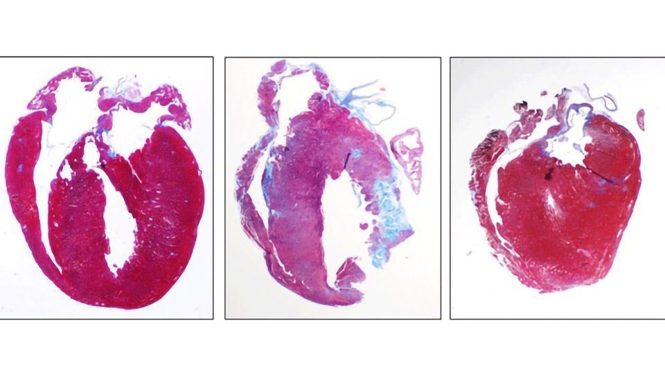 Drug Treats Inflammation Related to Genetic Heart Disease content piece image