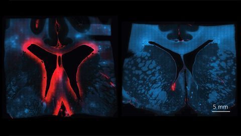 Blood Protein Protects Against Neuronal Damage After Brain Hemorrhage