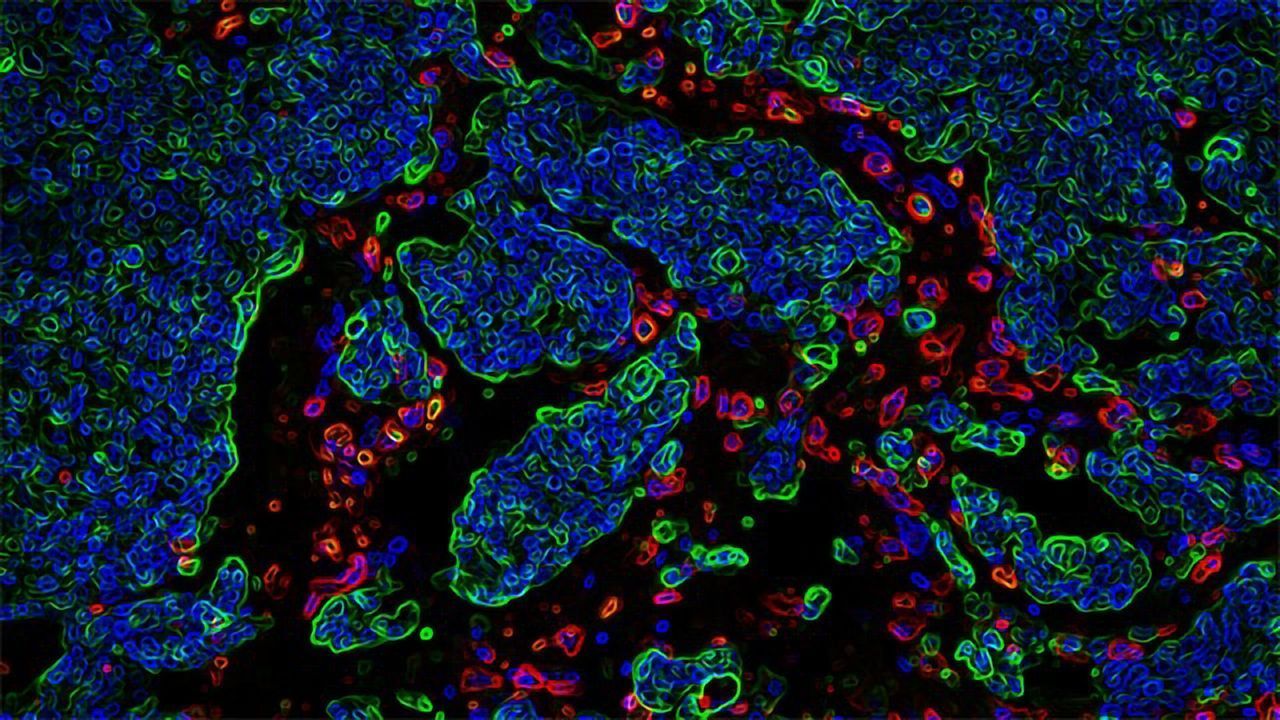 Why Tumor Cells Invade Distant Organs