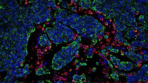 Why Tumor Cells Invade Distant Organs