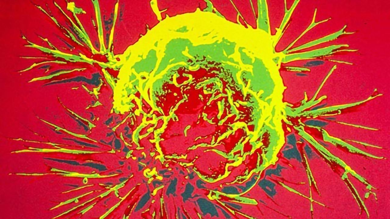 Attacking Metastatic Breast Cancer With Soundwaves