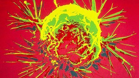 Attacking Metastatic Breast Cancer With Soundwaves