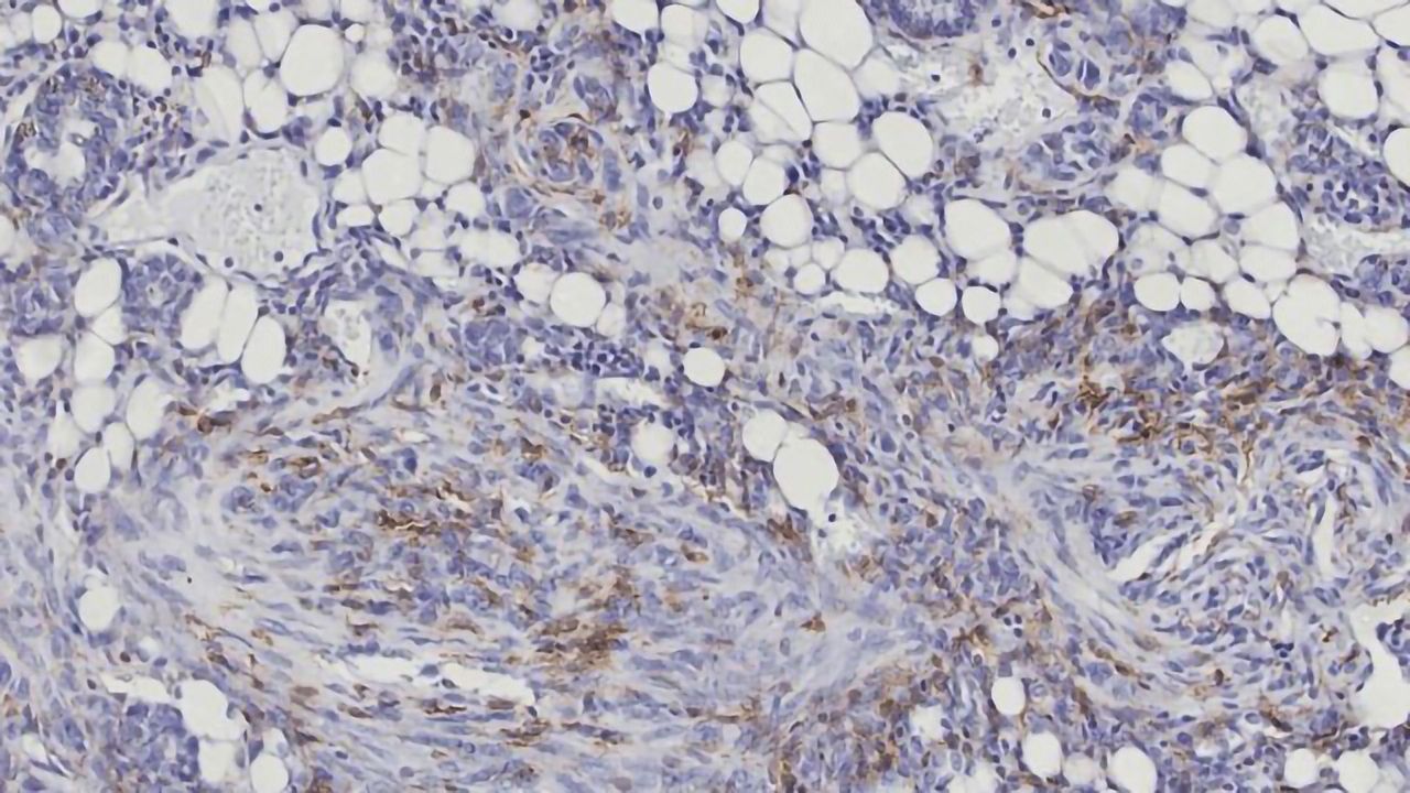 A New Way To Identify Aggressive Breast Cancer