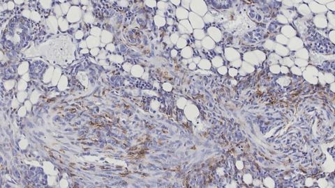 A New Way To Identify Aggressive Breast Cancer