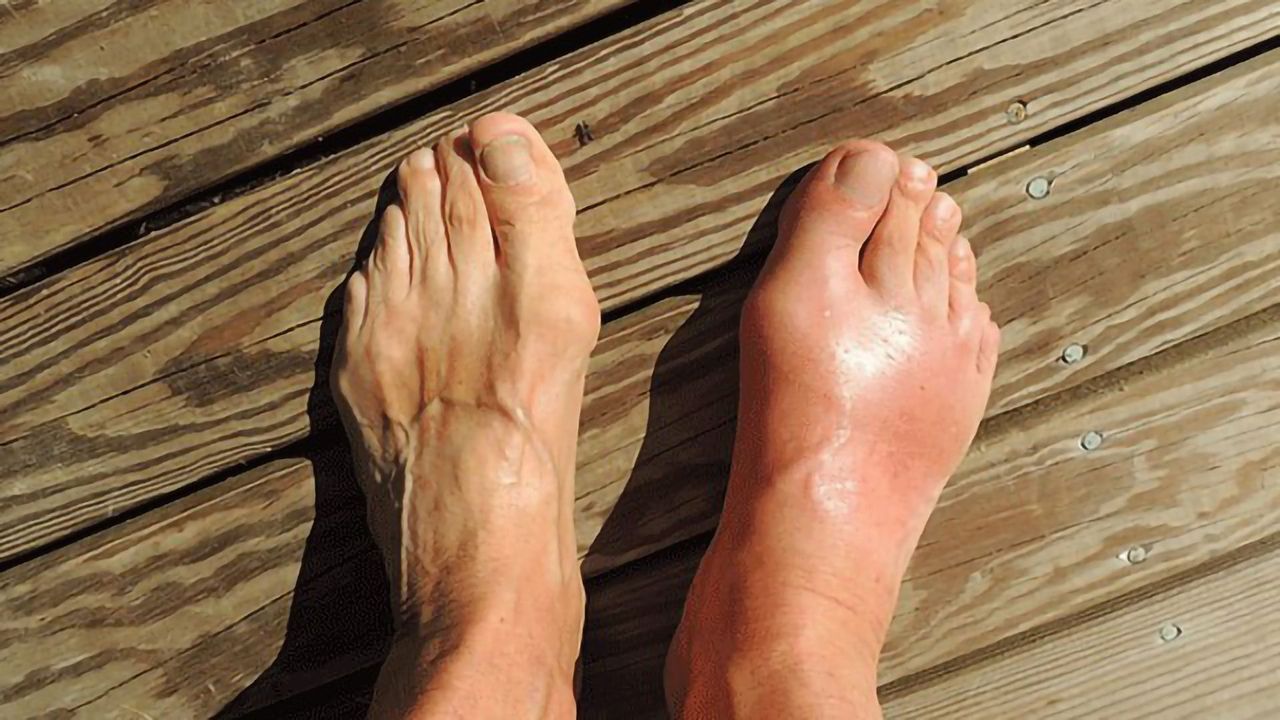 New Target for Treatment of Gout