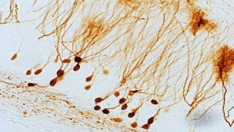 Preclinical Study of Gene Therapy for Epilepsy Shows Long-term Suppression of Seizures
