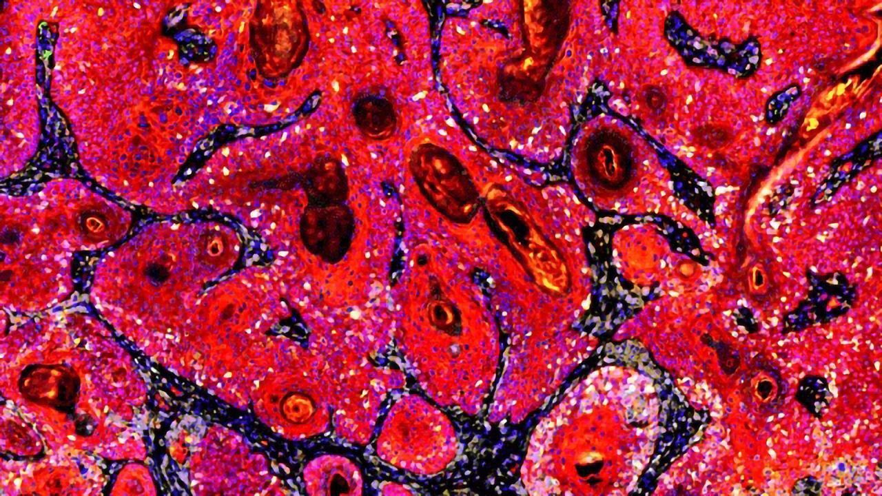 Immune Response Against Skin-dwelling Viruses Stops Cancer
