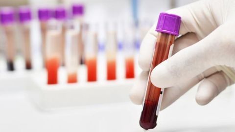Simple Blood Test for Early Detection of Breast Cancer