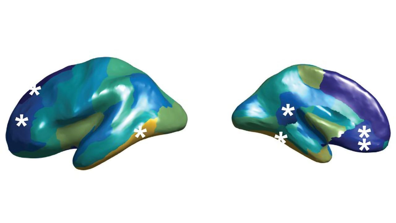 Why People With Autism Have a More Symmetrical Brain