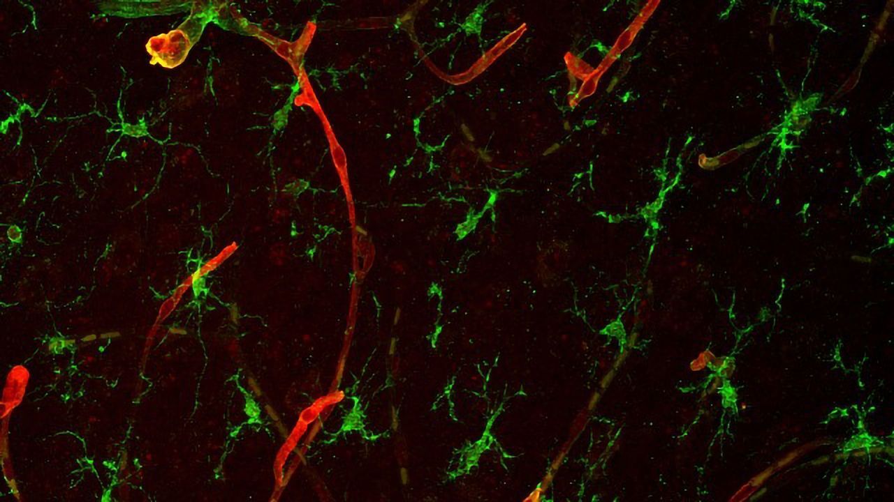 Scientists Identify Protein that Promotes Brain Metastasis