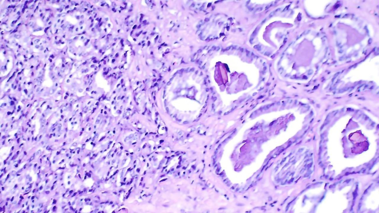 Experts Advise That Men Over 40 With BRCA2 Gene Fault Get Regular PSA Screening