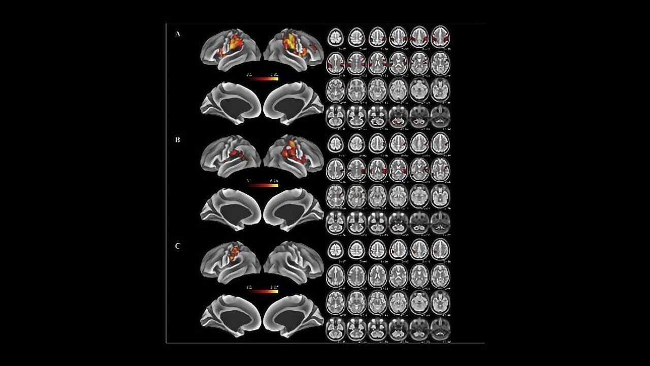 What Happens to Our Brain Maps If We Lose a Hand?