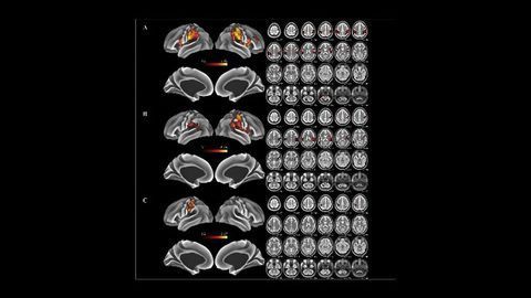 What Happens to Our Brain Maps If We Lose a Hand?