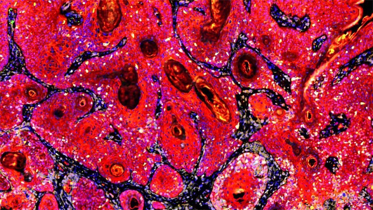 Immune Cells Attacking Cancer