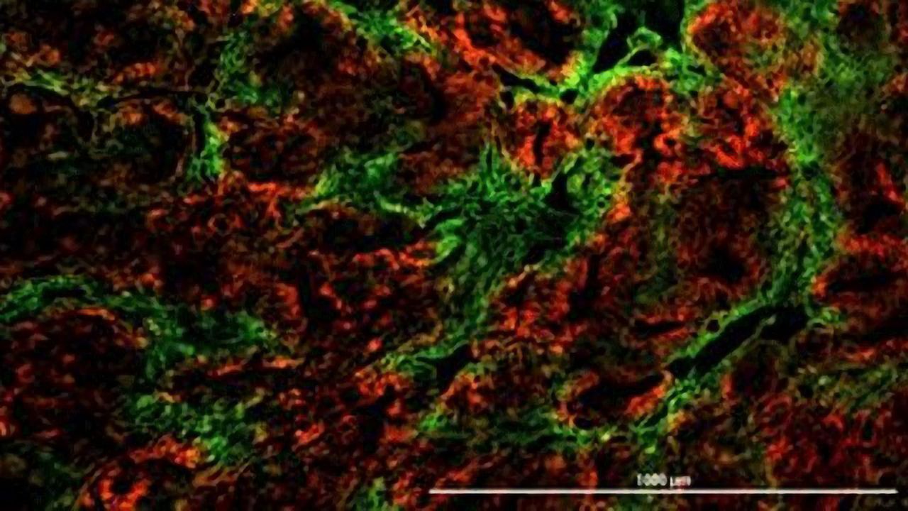 Oxygen-starved Cancer Cells Have Survival Advantage That Promotes Spread