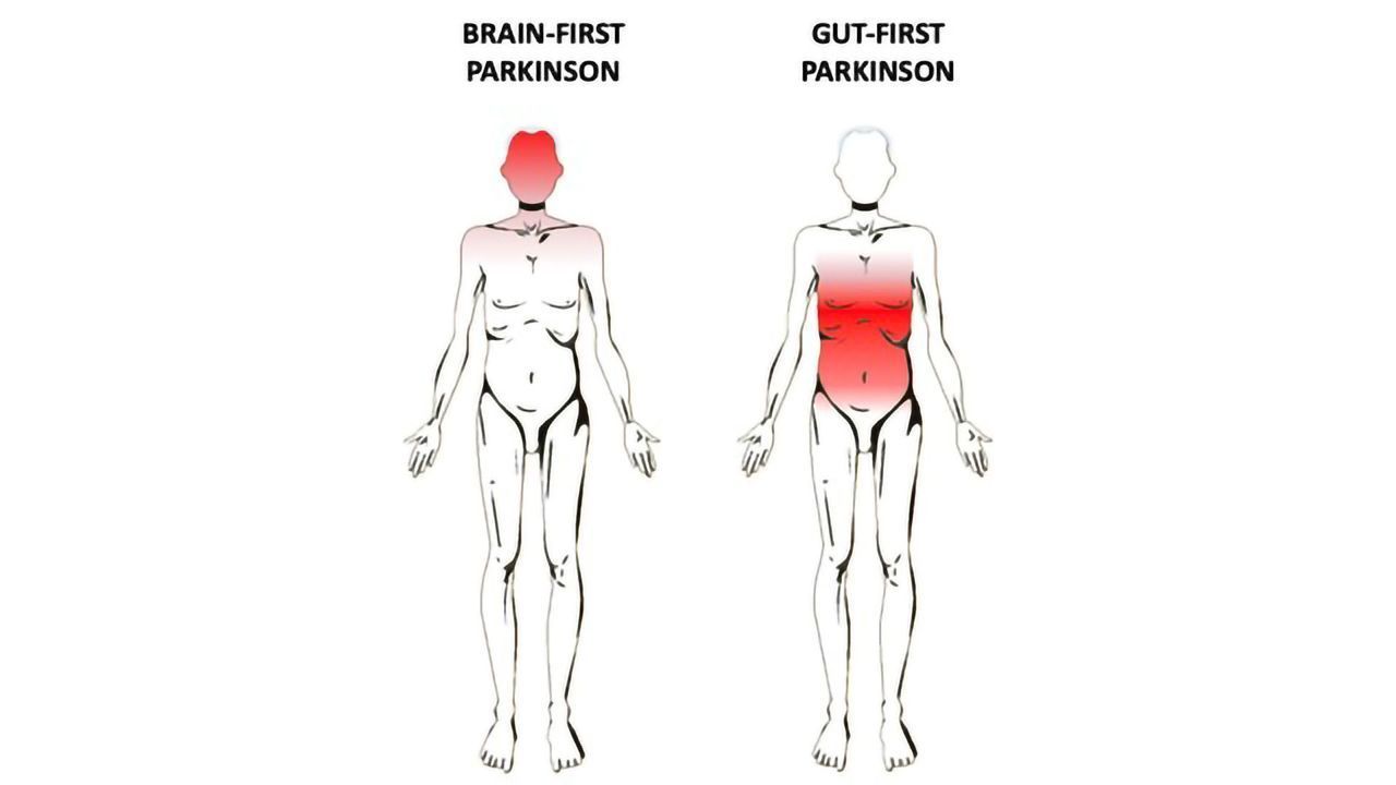 Does Parkinson's Begin in the Gut or the Brain? Or Both?