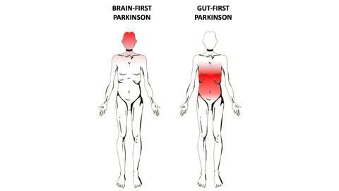 Does Parkinson's Begin in the Gut or the Brain? Or Both?