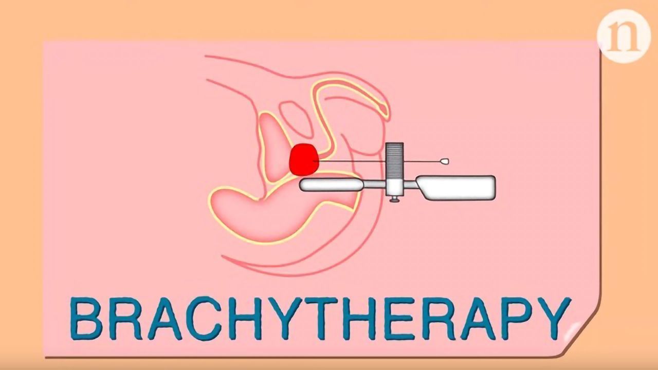 Prostate Cancer: Brachytherapy’s Fight for Survival
