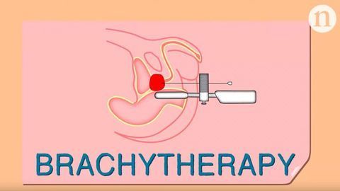 Prostate Cancer: Brachytherapy’s Fight for Survival