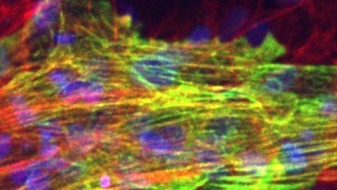 Heart Attack Modeled With Human Stem Cells