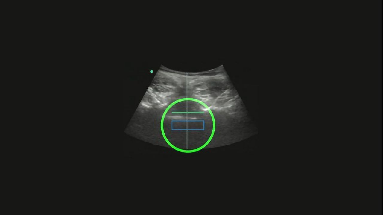 Automated Tool for Spinal Anesthesia Produces High Success Rate