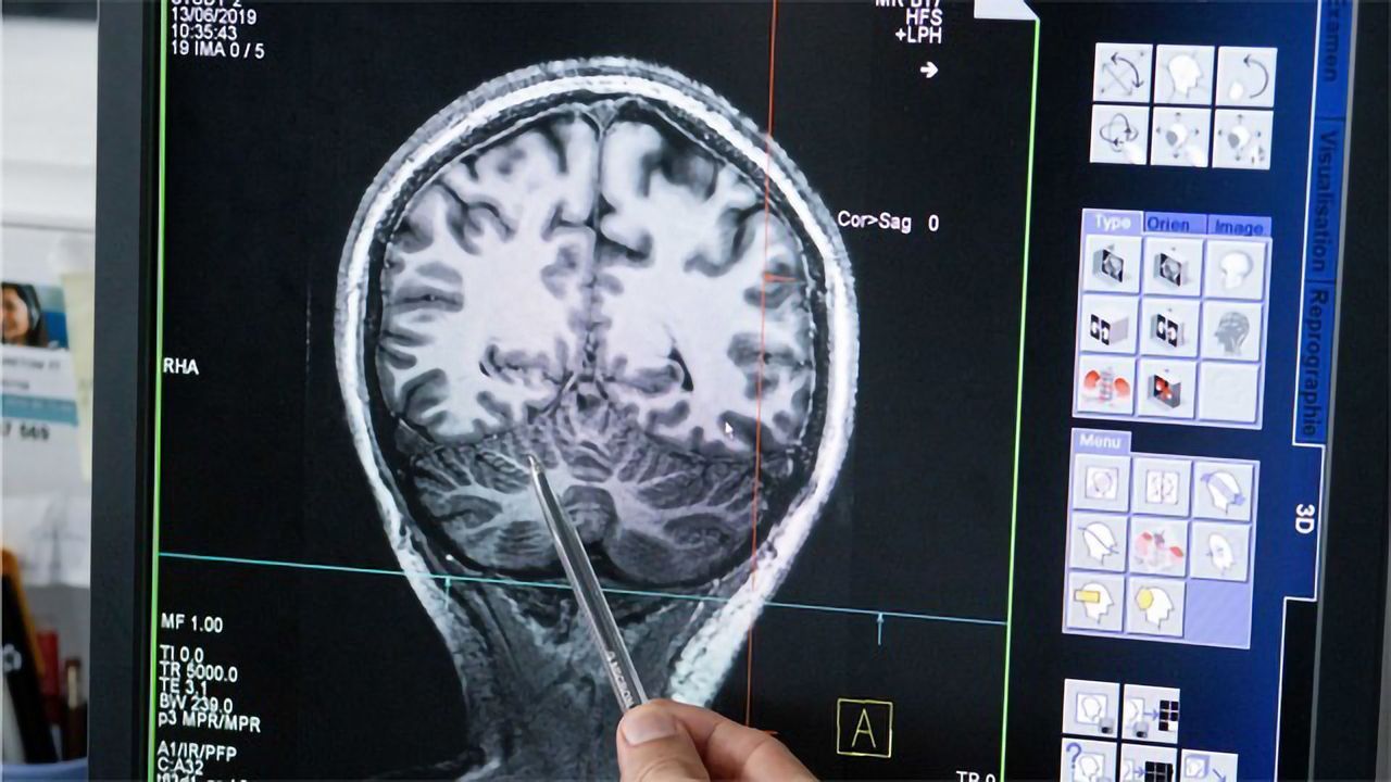 Simulation-based Method To Target Epilepsy Goes to Clinical Trials